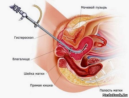 Гистероскопия