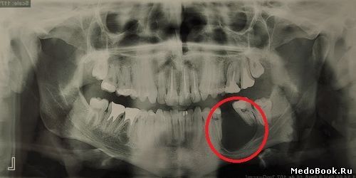 Киста челюсти на рентгене