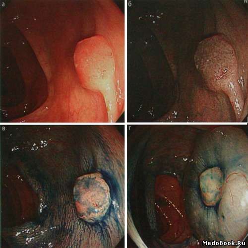 Признаки отсутствия лифтинга малигнизированного «сидячего» полипа