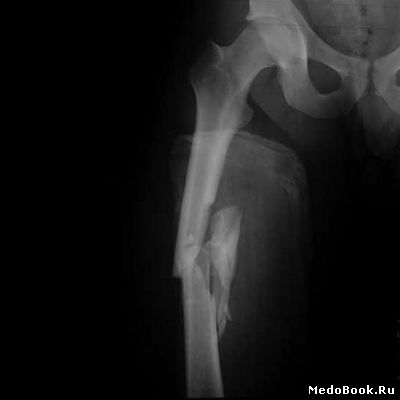 Рентгенодиагностика переломов диафиза бедренной кости