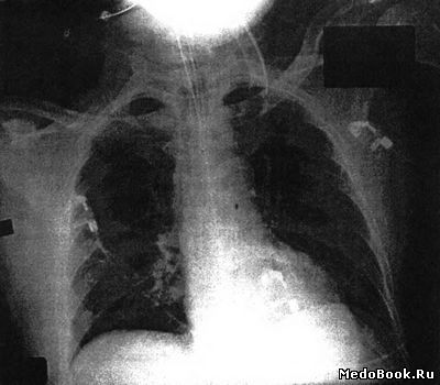 Рентгенограмма грудной клетки
