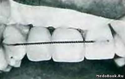 Реплантация зубов