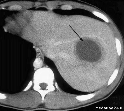 Гематома печени