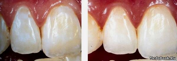 Белая пигментация при флюорозе до и после лечения