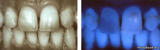 Черно-белые фотографии и фотографии в УФ-свете зубов