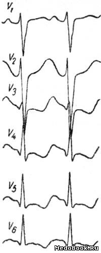 Изадриновая проба (выраженная депрессия сегмента ST в V3-6)