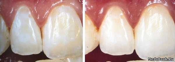 «Леопардовые» зубы до и после отбеливания
