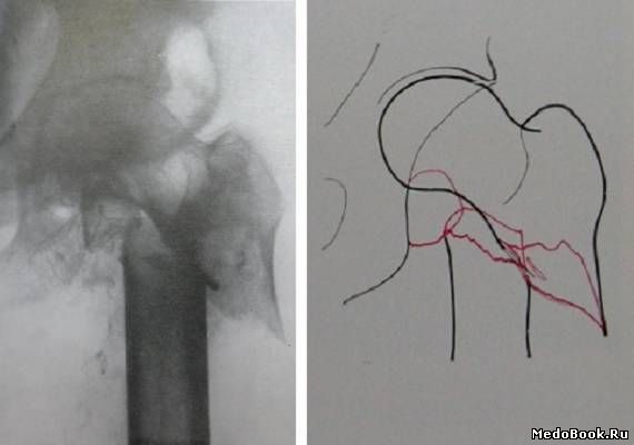 Медиальный подвертельный перелом 