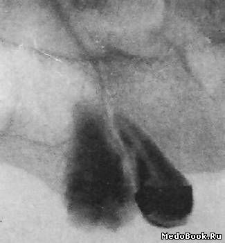 Одонтома на тангенциальной рентгенографии верхней челюсти