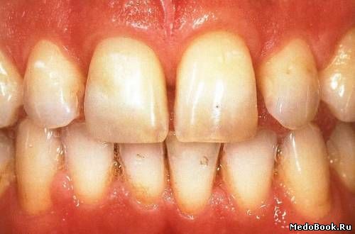 Пациент с окрашиванием зубов и существующих реставраций