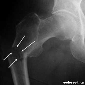 Рентген подвертельного перелома бедренной кости