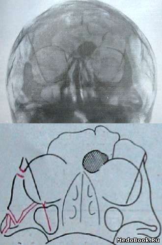 Рентгеновский снимок в полуаксиальной проекции 