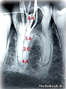 Стереорентгенограмма зуба