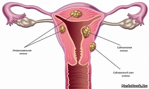 Виды миомы матки