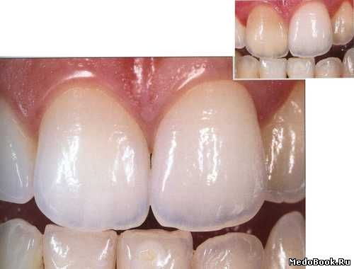 Витальное отбеливание зубов