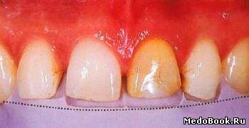 Изменение объема и длины зуба