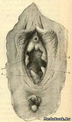 Наружные половые органы женщины при третьей беременности (с - carunculae niyrtiforines)