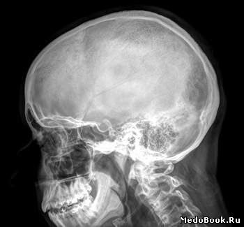 Обзорная рентгенография черепа менингиомы