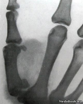 Перелом Беннета на боковом рентгеновском снимке