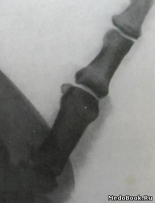 Перелом Беннета на прямом рентгеновском снимке