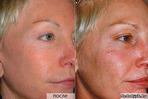 Ретиноловый пилинг лица (фото до и после)