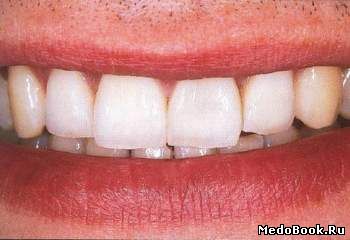 Связная композиция после адгезивной керамической реставрации зубов верхней челюсти и нижней губы