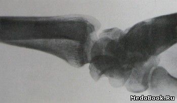 Боковой снимок 2 фазы тыльного перилунарного вывиха кисти руки