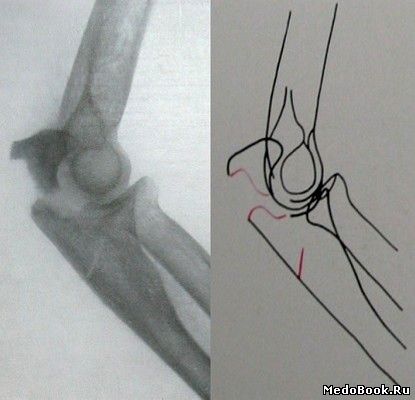Боковой снимок перелома локтевого отростка локтевой кости