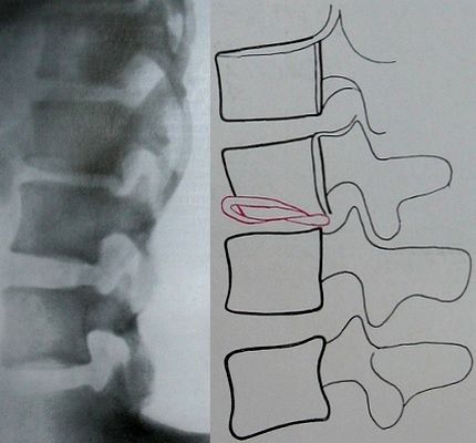 Боковой рентгеновский снимок отлома нижнего края 1 поясничного позвонка