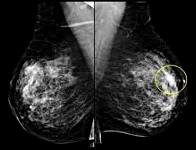 Мастопатия на маммограмме