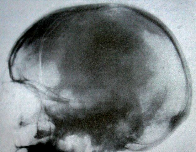 Перелом лобной и теменной костей на боковых снимках черепа