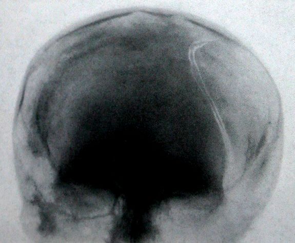 Перелом лобной и теменной костей на прямых снимках черепа