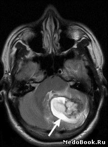 Перитуморозный отек головного мозга на МРТ (фронтальный срез)