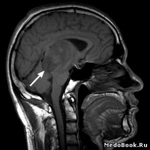 Перитуморозный отек головного мозга на МРТ (сагиттальный срез)