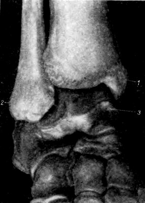 Правый голеностопный сустав, articulatio talocruralis, спереди