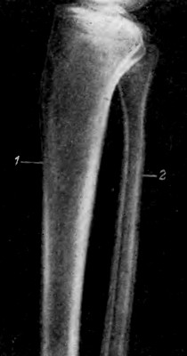 Рентгеновский снимок левой голени в боковой проекции
