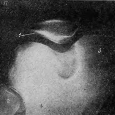 Рентгеновский снимок правого надколенника в осевой проекции