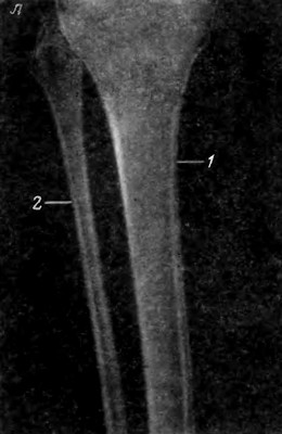 Рентгеновский снимок проксимального отдела левой голени в прямой задней проекции