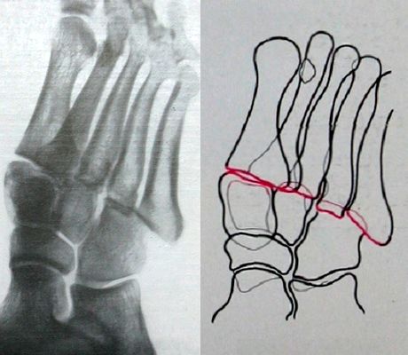 Рентгеновский снимок вывиха в Лисфранковом суставе в косой проекции