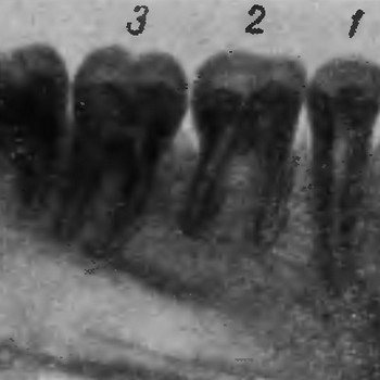 Рентгеновский снимок задних зубов нижней челюсти
