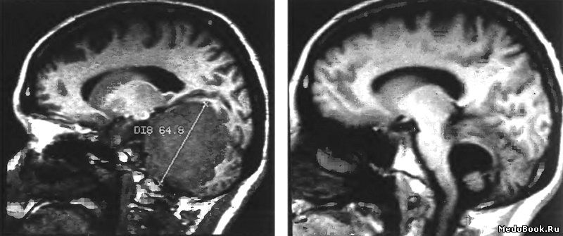 Супра-субтекториальное распространение менингиомы намета мозжечка