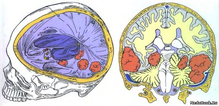 Варианты расположения менингиом намета мозжечка