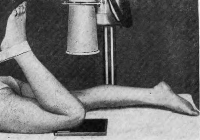 Укладка больного при проведении рентгенографии надколенника в осевой передней проекции (вид сбоку)