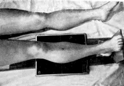 Укладка больного при проведении рентгенографии голени в прямой задней проекции (вид сверху)