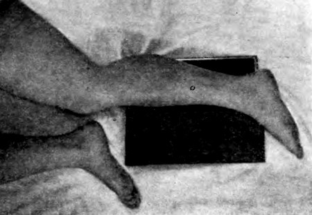Укладка больного при проведении рентгенографии голени в боковой проекции (вид сверху)