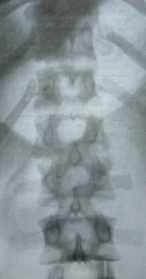Задний рентгеновский снимок отлома нижнего края 1 поясничного позвонка
