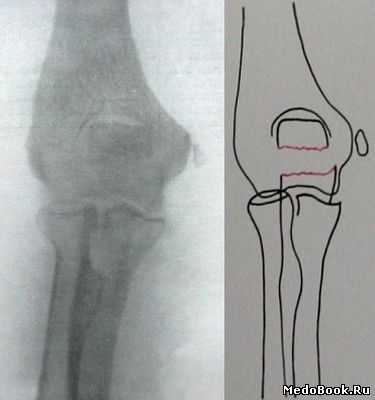 Задний снимок перелома локтевого отростка локтевой кости