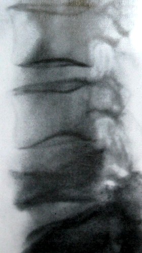 Боковой рентгеновский снимок перелома 4 поясничного позвонка по продольной оси