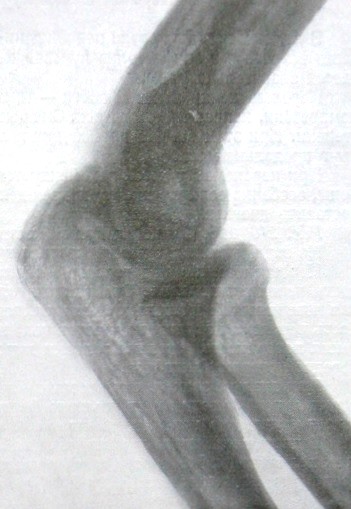 Боковой рентгеновский снимок перелома головки лучевой кости
