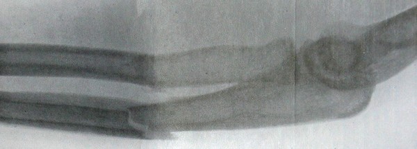 Боковой рентгеновский снимок перелома предплечья на границе между верхней и средней третями